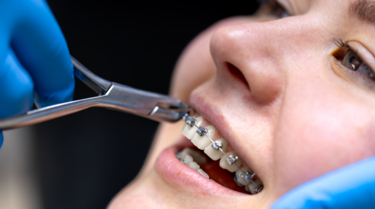 Featured image for “Adult Braces: A Confident Smile at Any Age”