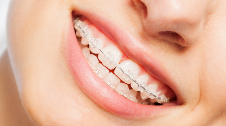 Featured image for “Clear Braces: A Discreet Way to Straighten Your Smile”
