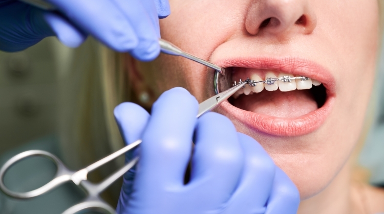 Featured image for “Orthodontic Treatment: A Guide to Straightening Your Smile”