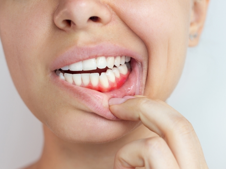Featured image for “What Causes Gum Bleeding and What Your Dentist Wants You to Know”